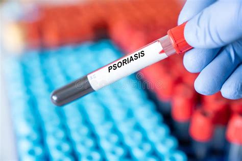 psoriasis blood test results